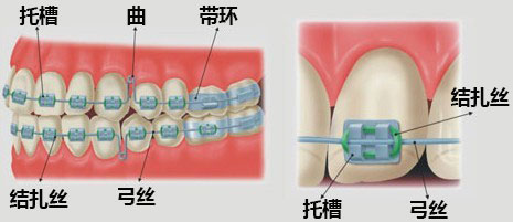 金属托槽矫正与隐形矫正介绍和对比2.jpg