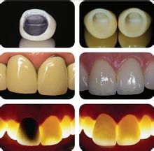 烤瓷牙有哪些种类_价格是多少3.jpg