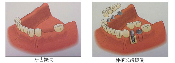 牙齿缺失修复方法2.jpg