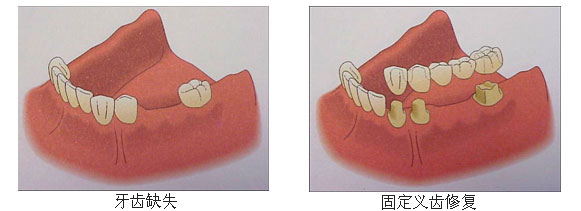 牙齿缺失修复方法3.jpg