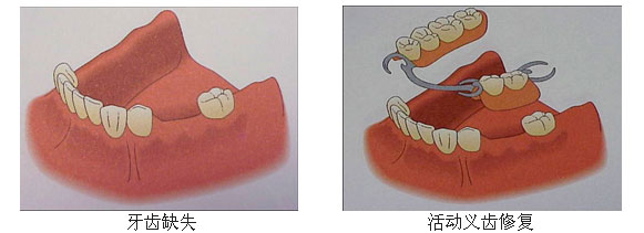 牙齿缺失修复方法4.jpg